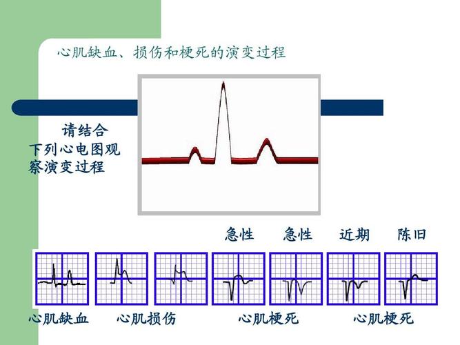 心电图基本常识 - 心电图基本常识,做一个相关PPT 第7张 心电图基本常识 - 心电图基本常识,做一个相关PPT 第7张