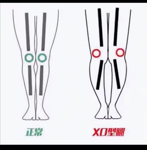 怎么矫正ox型腿小常识 - ox型腿矫正器矫正有效吗 第1张 怎么矫正ox型腿小常识 - ox型腿矫正器矫正有效吗 第1张