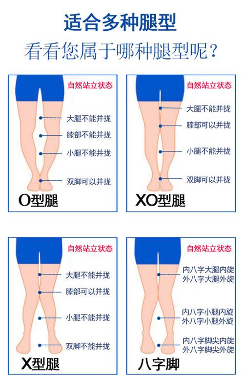 怎么矫正ox型腿小常识 - ox型腿矫正器矫正有效吗 第2张 怎么矫正ox型腿小常识 - ox型腿矫正器矫正有效吗 第2张