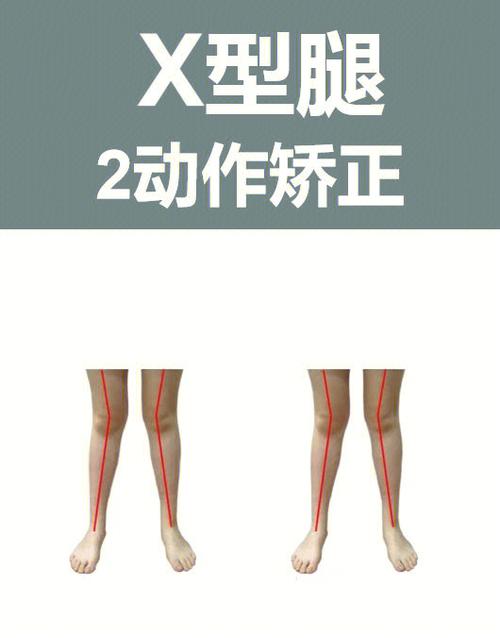 怎么矫正ox型腿小常识 - ox型腿矫正器矫正有效吗 第3张 怎么矫正ox型腿小常识 - ox型腿矫正器矫正有效吗 第3张