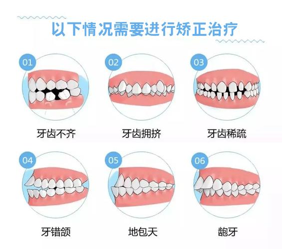 牙齿矫正常识 - 牙齿矫正相关知识 第1张 牙齿矫正常识 - 牙齿矫正相关知识 第1张