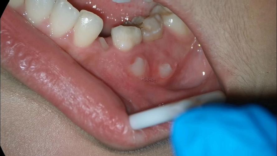 这个牙不取出行吗(牙齿可以不拔就装新牙?) 第2张 这个牙不取出行吗(牙齿可以不拔就装新牙?) 第2张