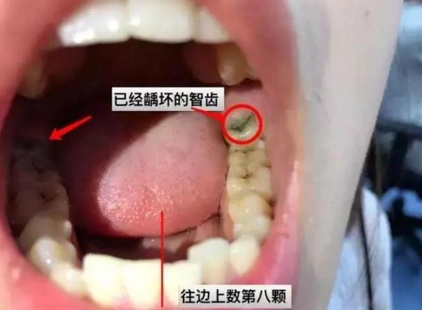 这个牙不取出行吗(牙齿可以不拔就装新牙?) 第4张 这个牙不取出行吗(牙齿可以不拔就装新牙?) 第4张