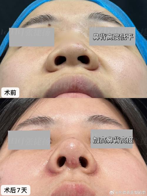鼻部整形常识(鼻部整形的常识) 第3张 鼻部整形常识(鼻部整形的常识) 第3张