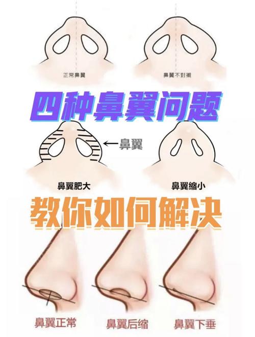 鼻部整形常识(鼻部整形的常识) 第7张 鼻部整形常识(鼻部整形的常识) 第7张