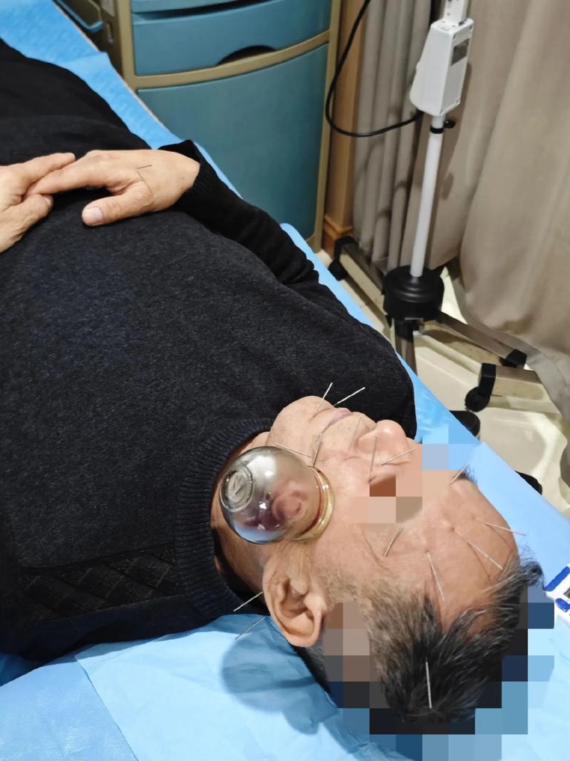 针灸后多久能骑摩托车出行,针灸完多久可以出门 第3张 针灸后多久能骑摩托车出行,针灸完多久可以出门 第3张