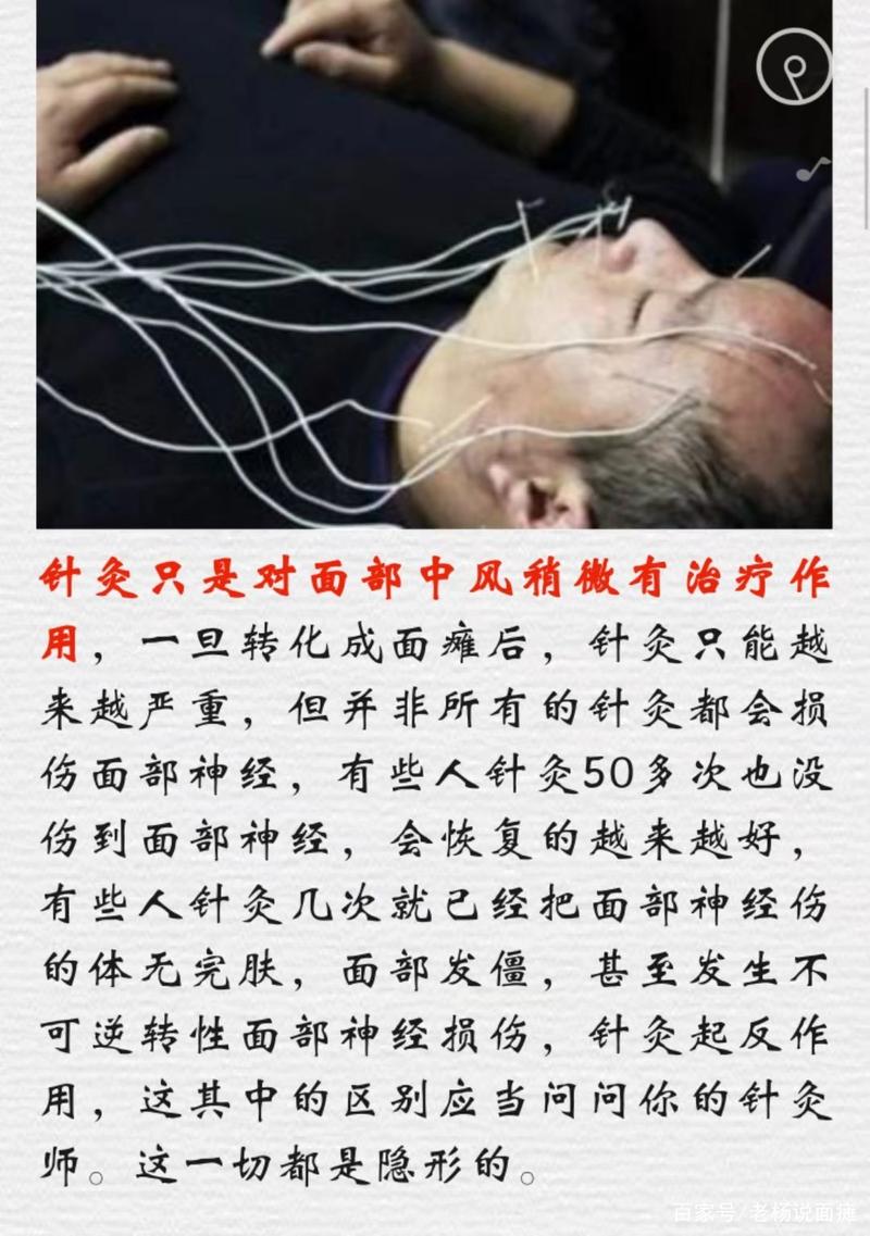 针灸后多久能骑摩托车出行,针灸完多久可以出门 第5张 针灸后多久能骑摩托车出行,针灸完多久可以出门 第5张