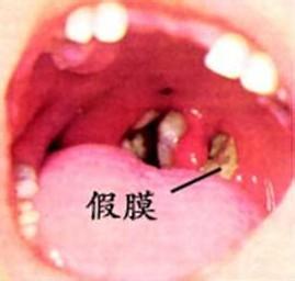 白喉症状最基本常识 - 白喉症状最基本常识是什么 第6张 白喉症状最基本常识 - 白喉症状最基本常识是什么 第6张