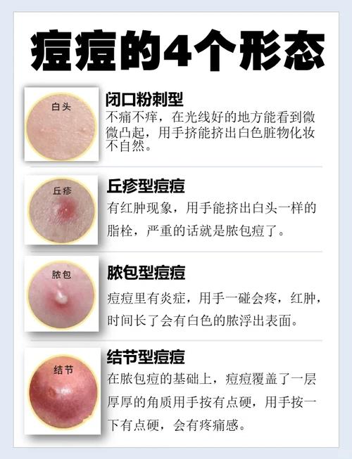 去痘痘小常识(去痘痘小妙方) 第4张 去痘痘小常识(去痘痘小妙方) 第4张