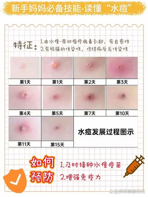 预防水痘小常识,预防水痘小常识10条 第2张 预防水痘小常识,预防水痘小常识10条 第2张
