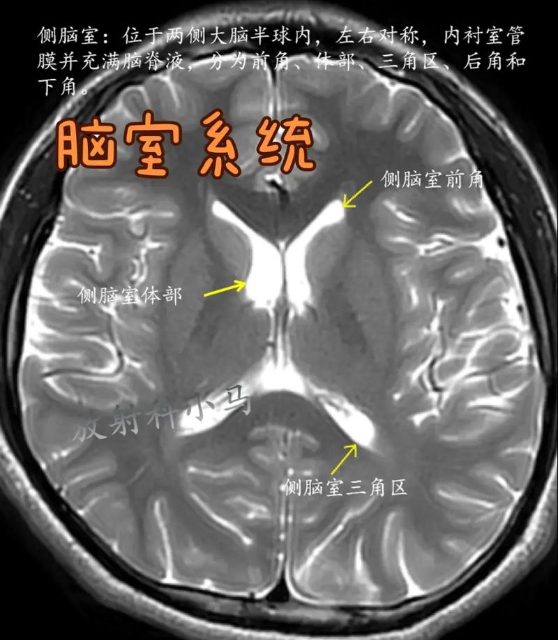 双侧侧脑室的常识讲述(双侧侧脑室的常识讲述错误的是) 第6张 双侧侧脑室的常识讲述(双侧侧脑室的常识讲述错误的是) 第6张