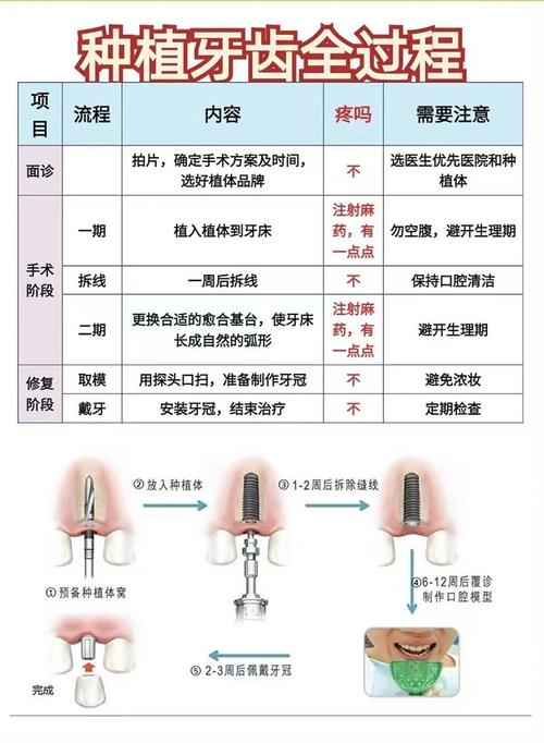种植牙常识种植牙介绍 - 种植牙详解 第4张 种植牙常识种植牙介绍 - 种植牙详解 第4张