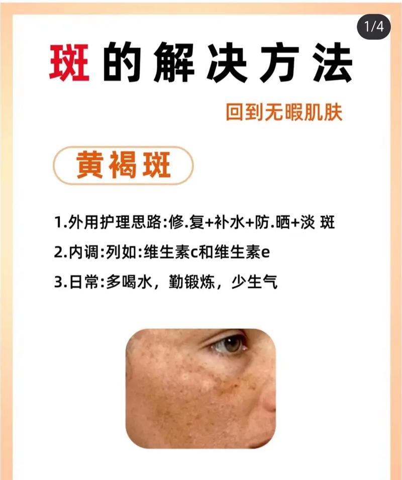 激光祛斑常识,激光祛斑常识知识点 第2张 激光祛斑常识,激光祛斑常识知识点 第2张