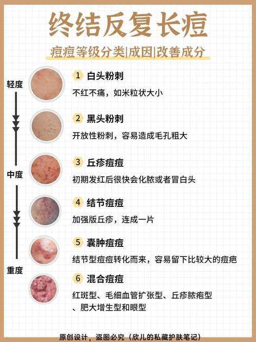 祛痘生活小常识,祛痘日常应该注意什么 第7张 祛痘生活小常识,祛痘日常应该注意什么 第7张