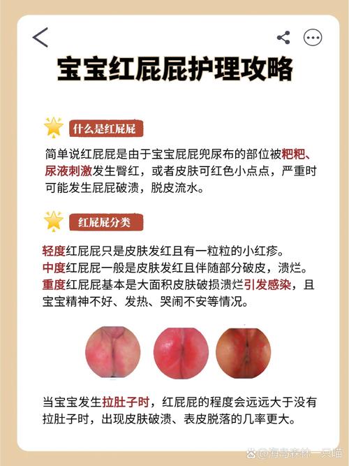 新生儿屁屁护理常识(新生儿屁屁怎样护理) 第4张 新生儿屁屁护理常识(新生儿屁屁怎样护理) 第4张