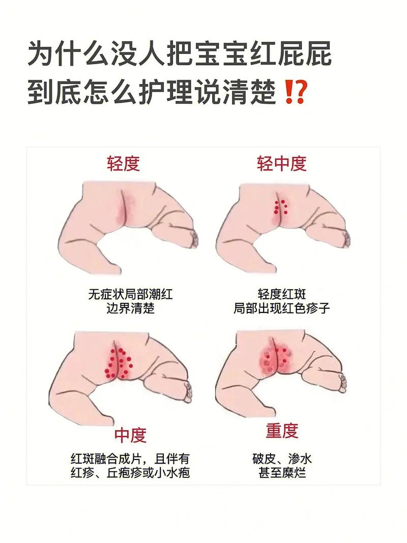 新生儿屁屁护理常识(新生儿屁屁怎样护理) 第8张 新生儿屁屁护理常识(新生儿屁屁怎样护理) 第8张