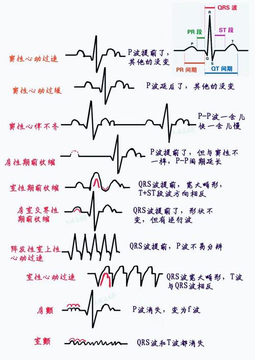 心律失常识别,心律失常识别及处理PPT 第5张 心律失常识别,心律失常识别及处理PPT 第5张